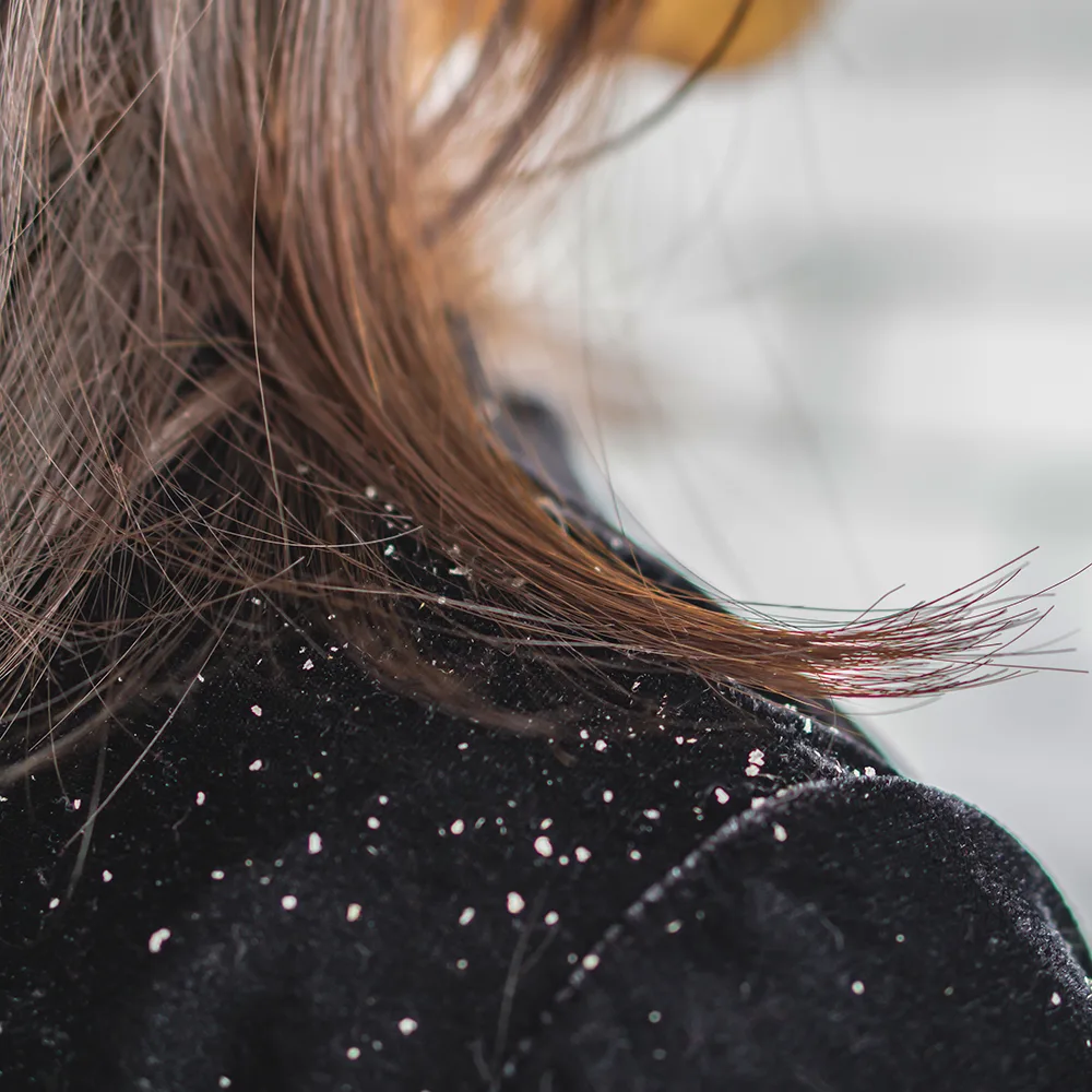 Şampuan Değişimi Kepeğe Sebep Olur mu?